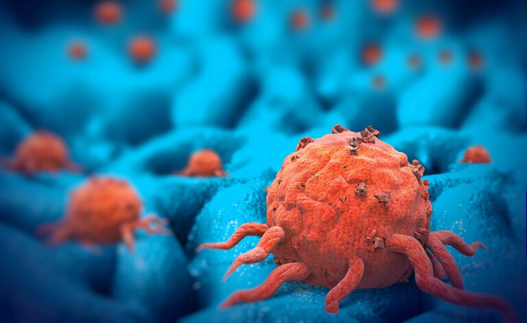 Sintomi E Cure Per Il Mieloma Multiplo