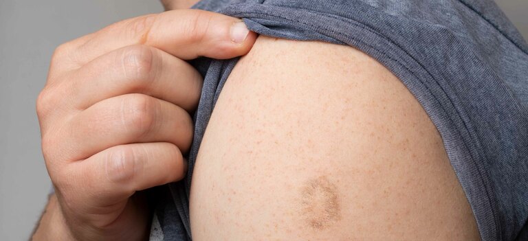 Scopriamo in cosa consiste il vaccino per il vaiolo delle scimmie