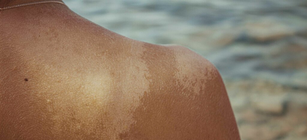 Come fronteggiare la dermatite atopica d'estate