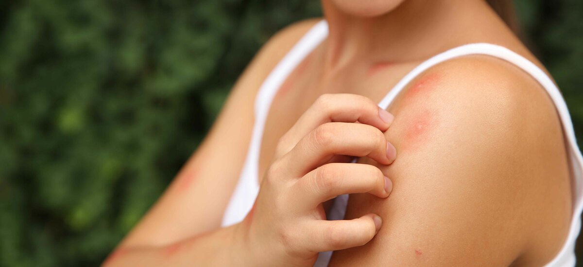 Scopriamo tutti i rimedi naturali contro le punture di zanzare