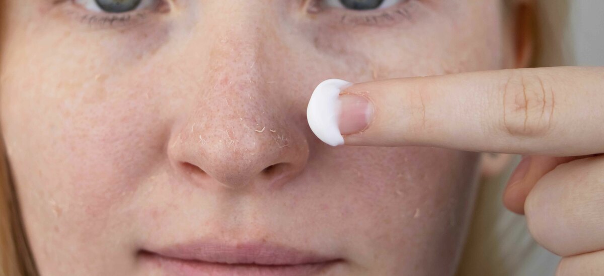 Scopriamo i rimedi per non spellarsi dopo la scottatura