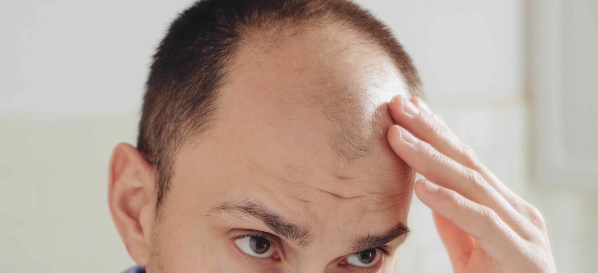 Alopecia androgenetica