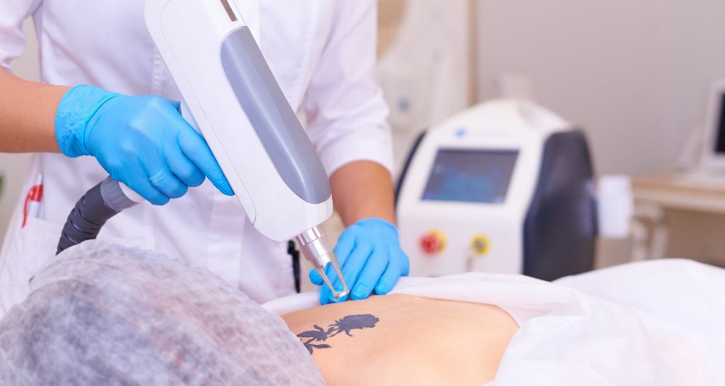 Rimozione tatuaggi: come funziona?