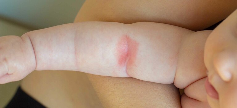 Ecco in cosa consistono i rimedi contro la sudamina nel neonato