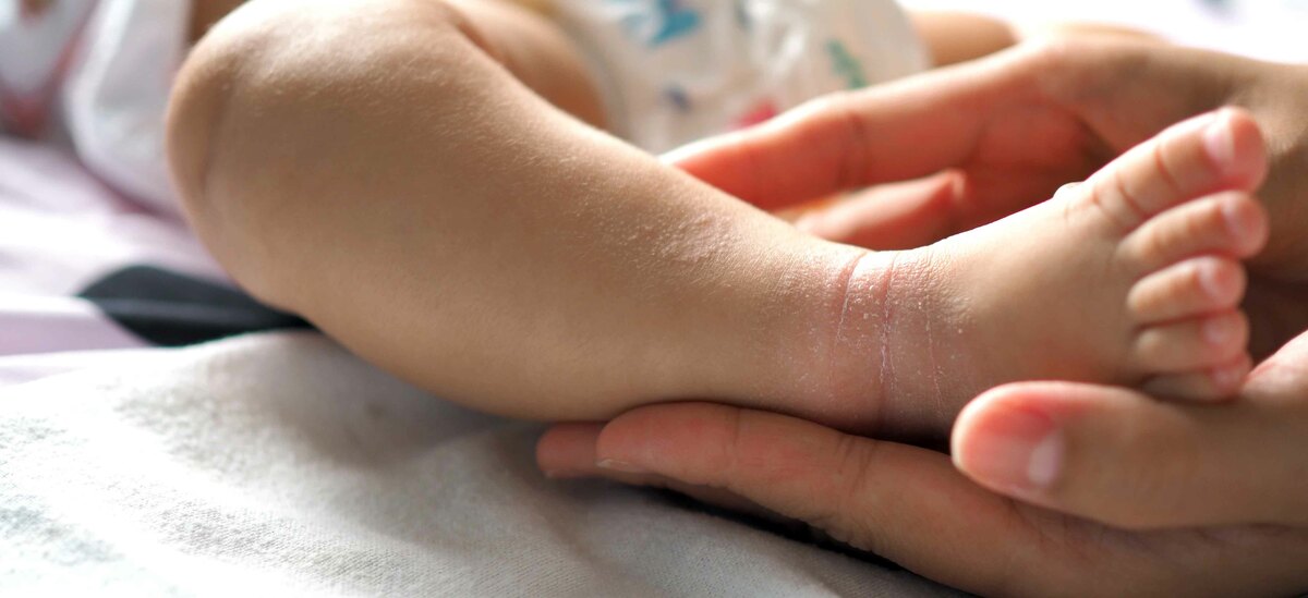 Cos'è la sudamina nel neonato