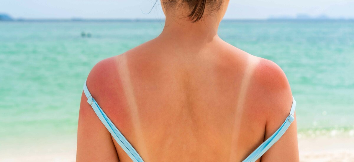 Ecco i rimedi per la scottatura solare