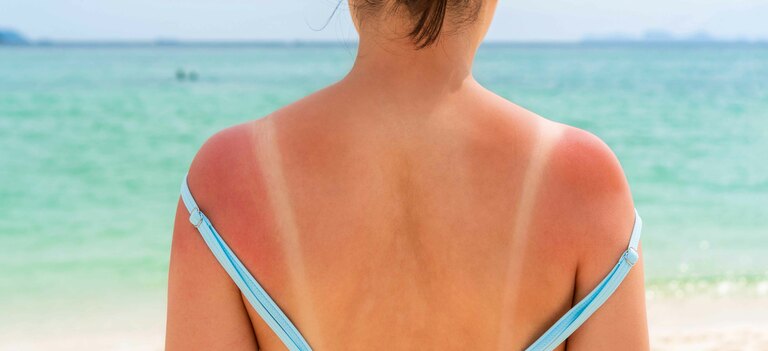 Ecco i rimedi per la scottatura solare