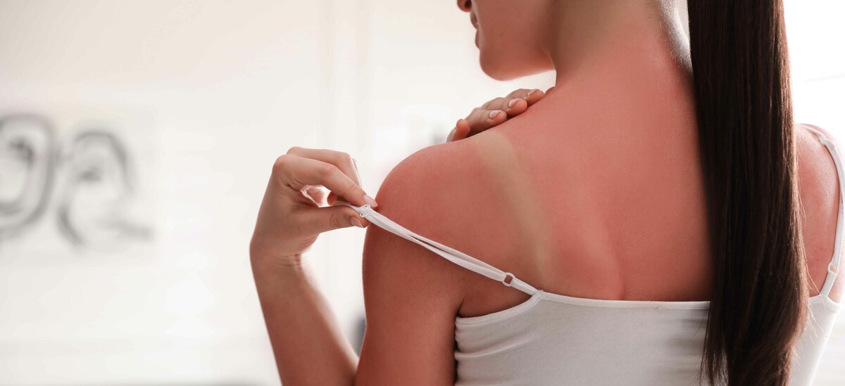 Cosa evitare dopo una scottatura