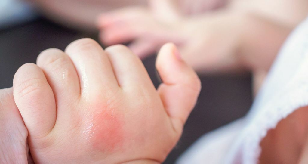 zanzara-e-neonato-come-proteggere-i-piu-piccoli-dalle-punture