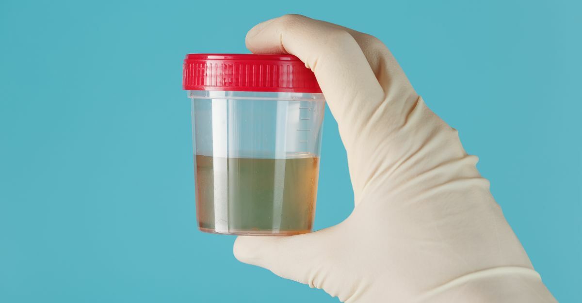 cellule-epiteliali-alte-nelle-urine