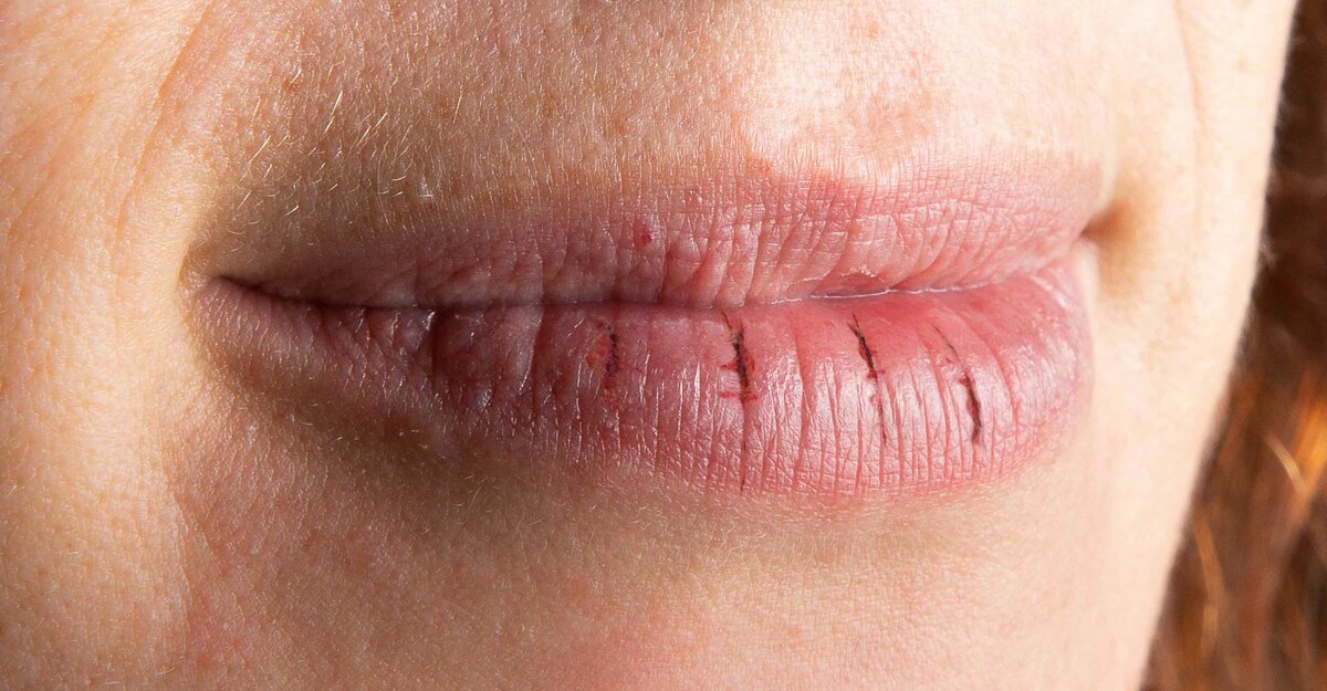 Donna con labbra secche