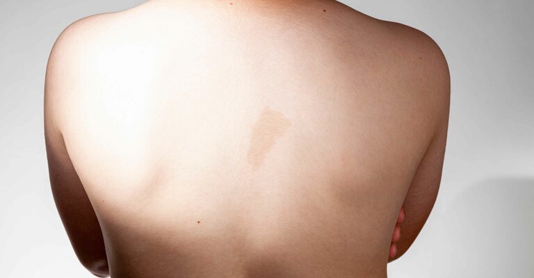 Scopriamo cosa sono le macchie caffelatte nei bambini