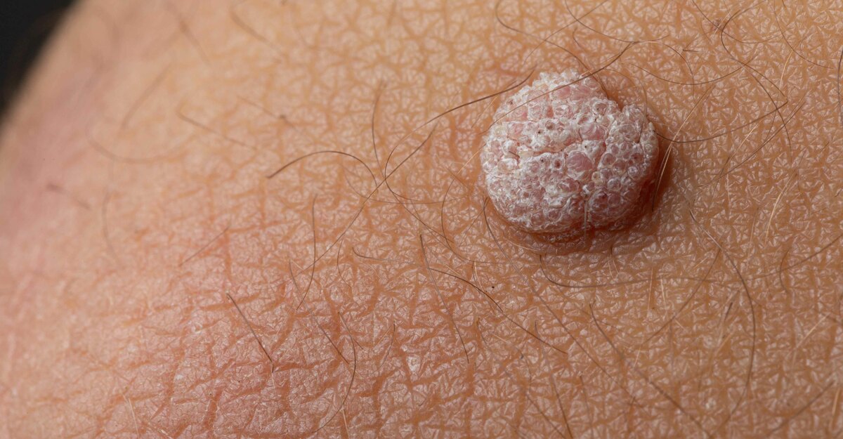 foto di una verruca
