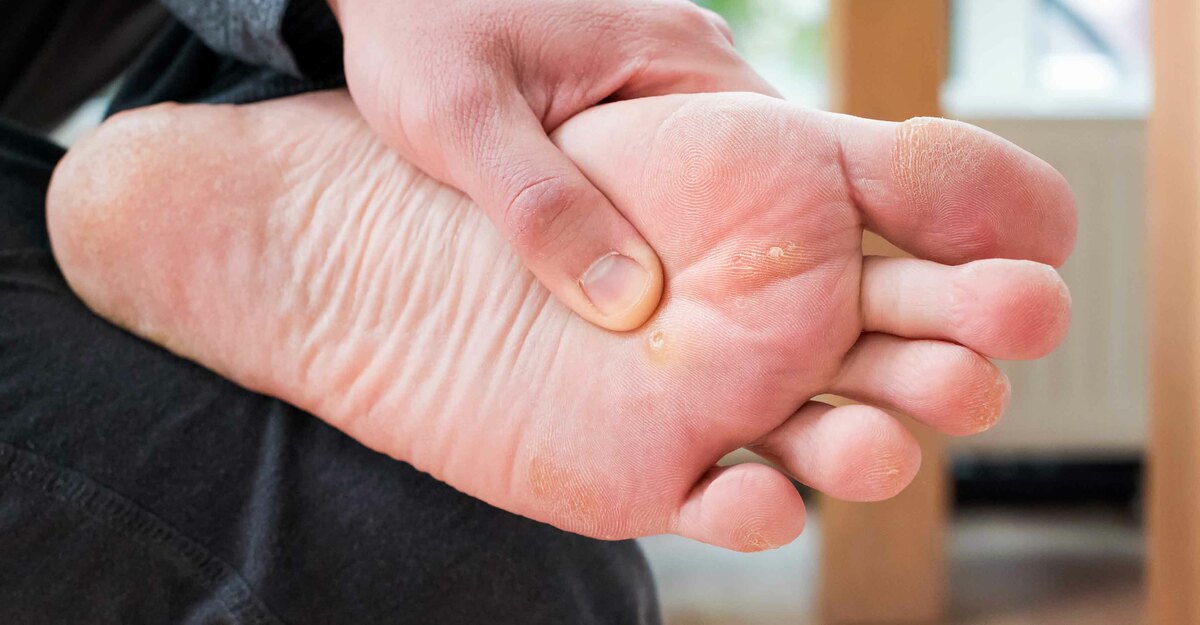 Foto di verruche piane