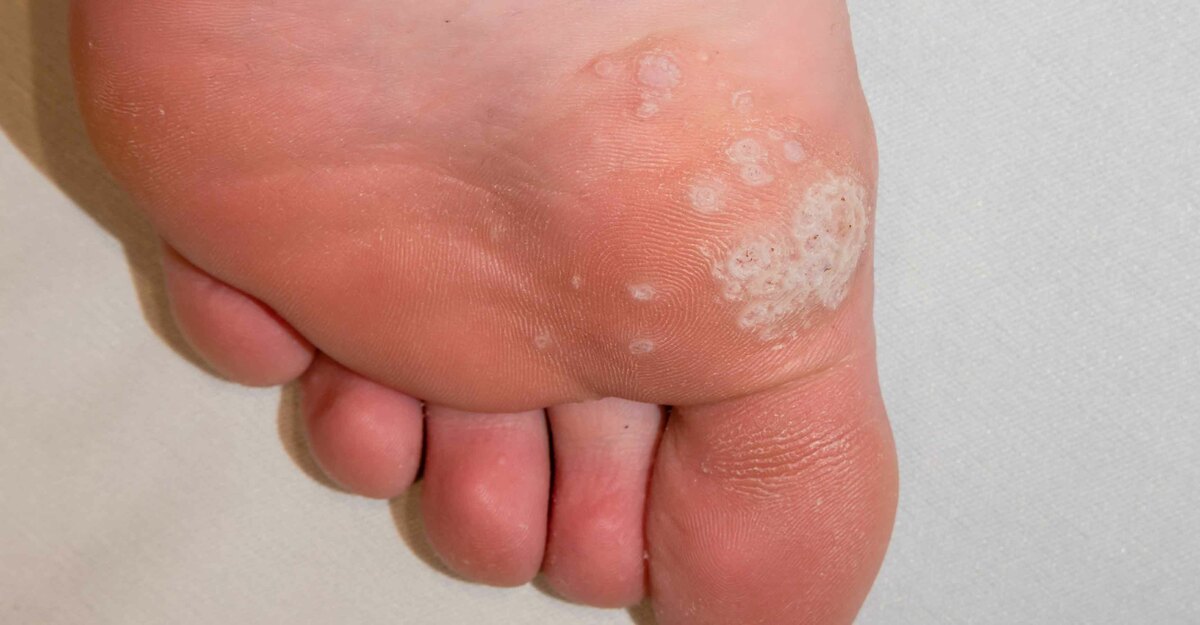 Foto di una verruca plantare