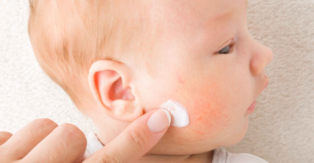 Genitore mette una crema sulla guancia arrossata del figlio neonato