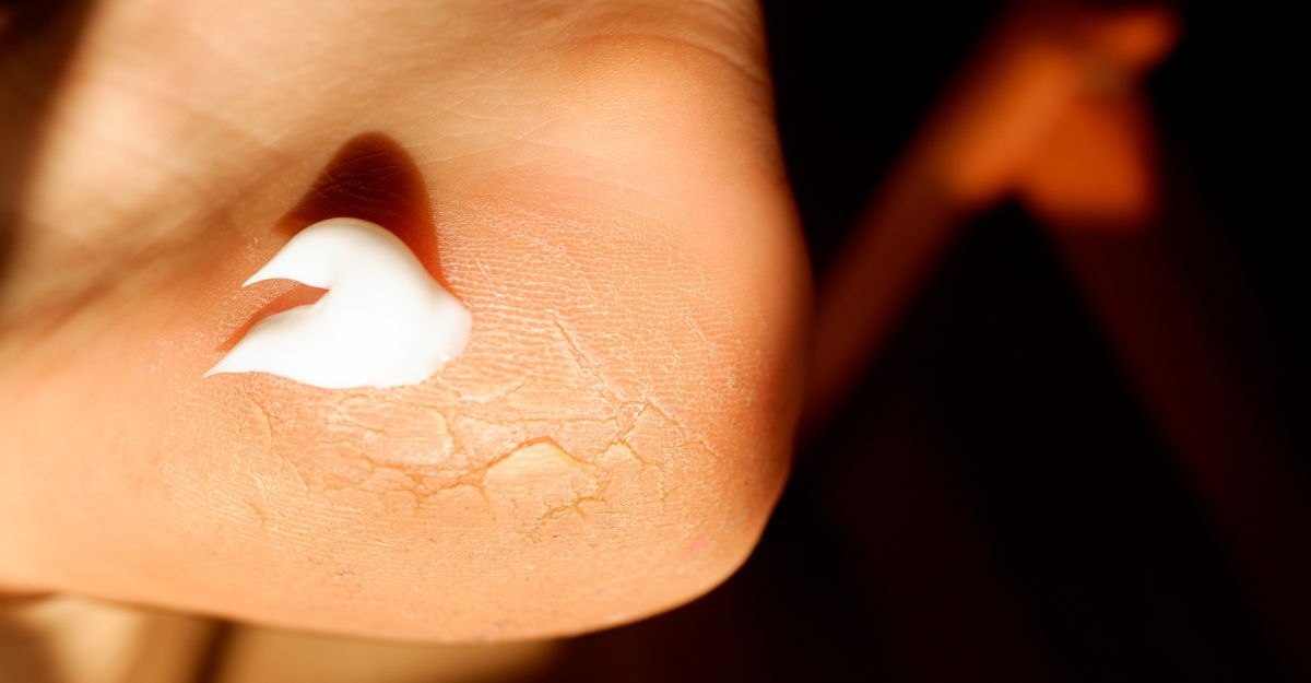 Una crema applicata sul tallone screpolato