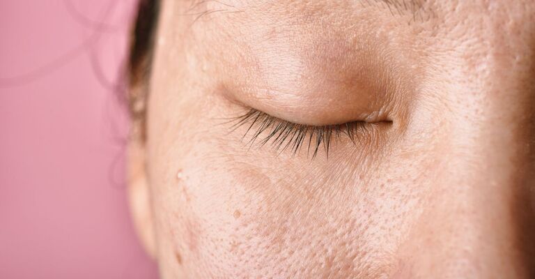 donna-con-macchie-cutanee-sul-viso