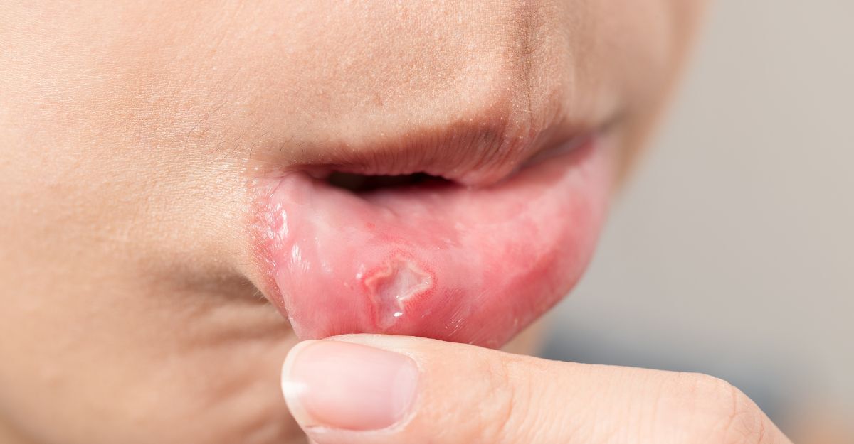 L'immagine di una donna con un Afta