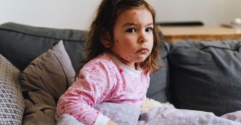 Una bambina con il morbillo