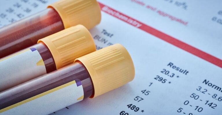 Tre provette di sangue con tappo giallo su un referto di analisi cliniche, con risultati e valori di riferimento visibili.