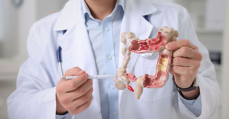Un medico tiene in mano un modello di intestino