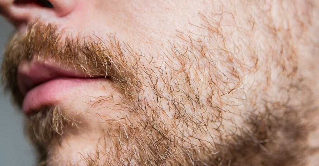 Primo piano di barba maschile con presenza di forfora tra i peli, segni di pelle secca o dermatite seborroica