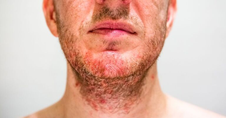 Un uomo con il viso irritato