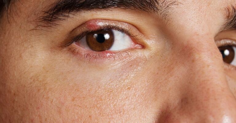 Primo piano di un occhio con una palpebra gonfia e rossa, e secrezione di pus.