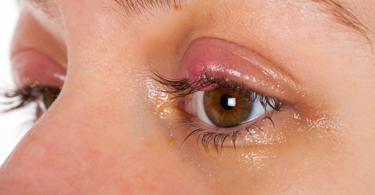 Primo piano di un occhio con un orzaiolo o un calazio sulla palpebra superiore.