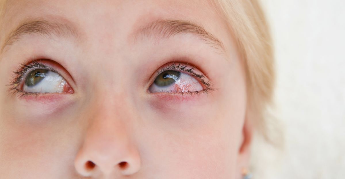 Una donna con l'occhio infiammato a causa della congiuntivite
