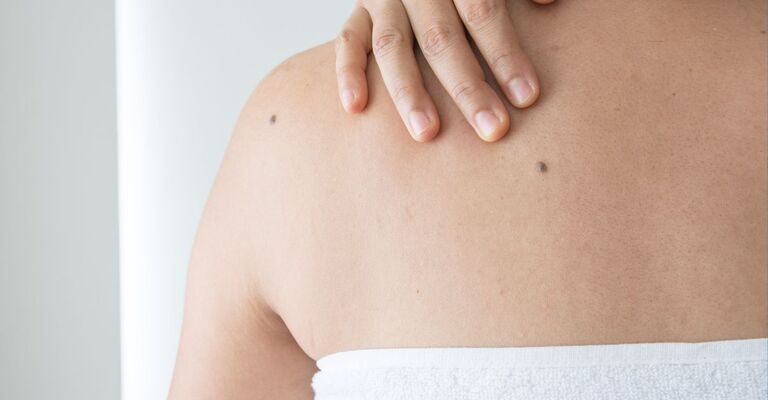 donna di schiena con un neo molto visibile
