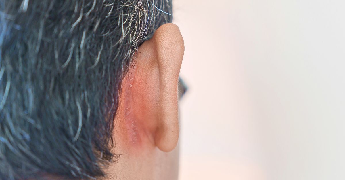 Un uomo con dermatite seborroica all'orecchio.