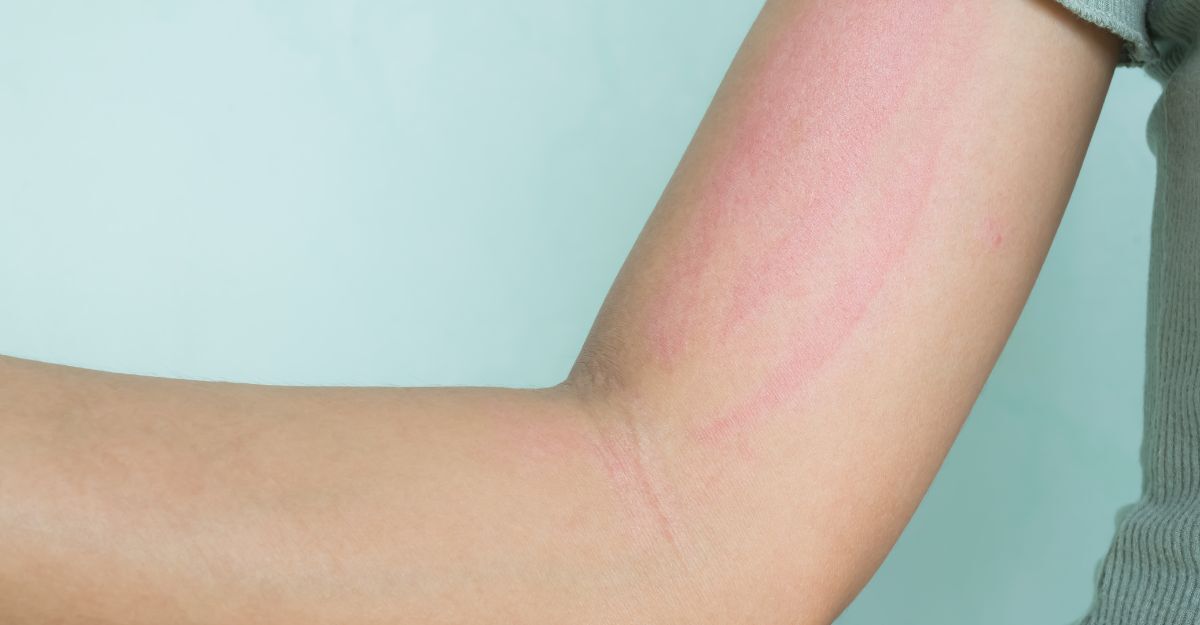 Una pelle con orticaria