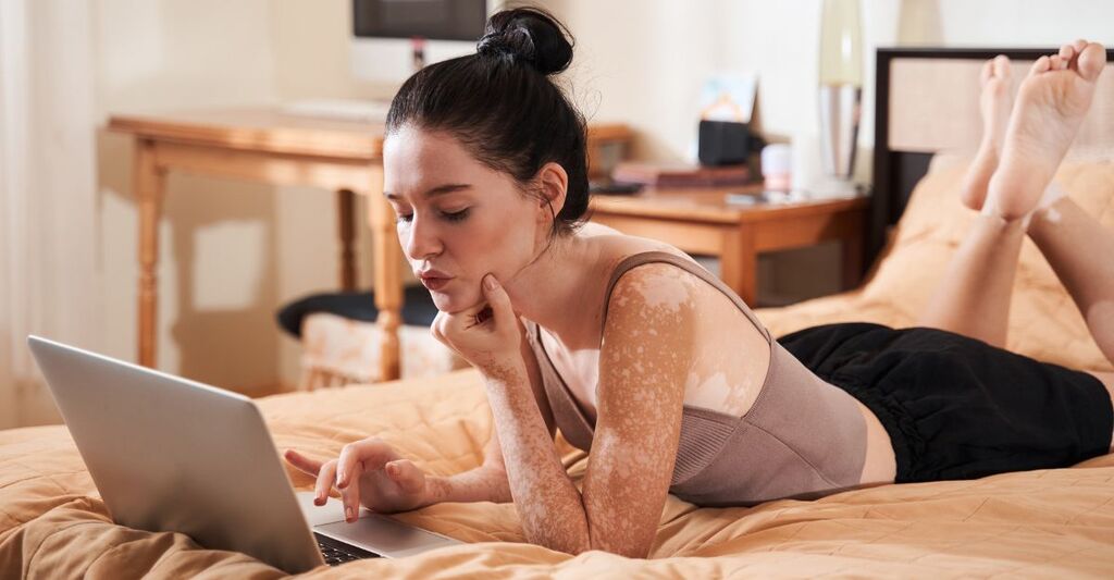 Donna con vitiligine, malattia autoimmune, che lavora al computer portatile