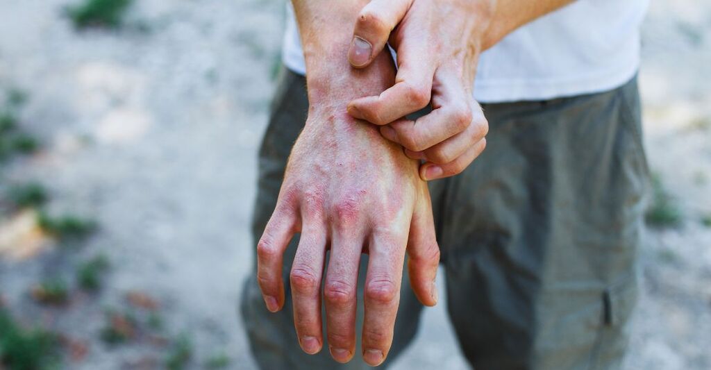 Il problema di molte persone: l'eczema alle mani. Sfondo di strada. Uomo con prurito, psoriasi, eruzioni cutanee rosse e macchie