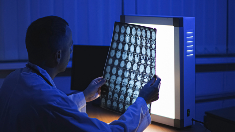 Un medico osserva una lastra di un cervello