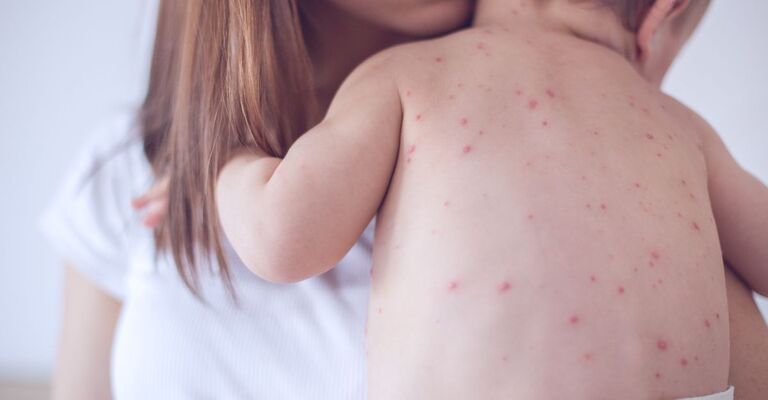 bambino con il morbillo, tenuto in braccio dalla mamma