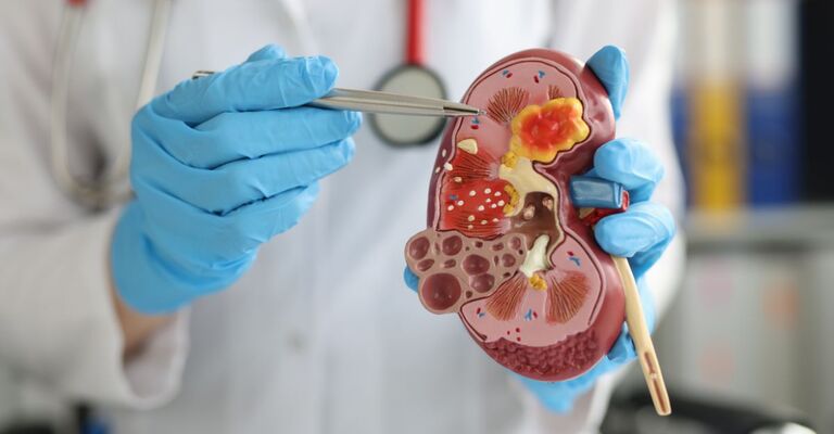 Un medico illustra la malattia renale cronica.