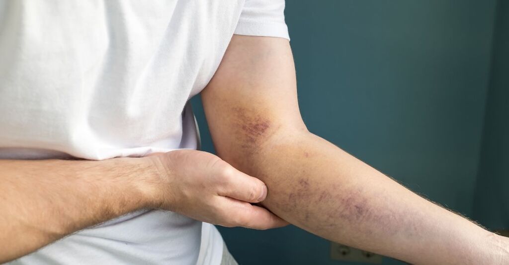 Un uomo con lividi sul braccio.