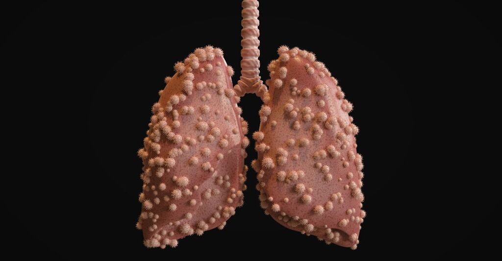 rappresentazione-di-polmoni-affetti-da-virus