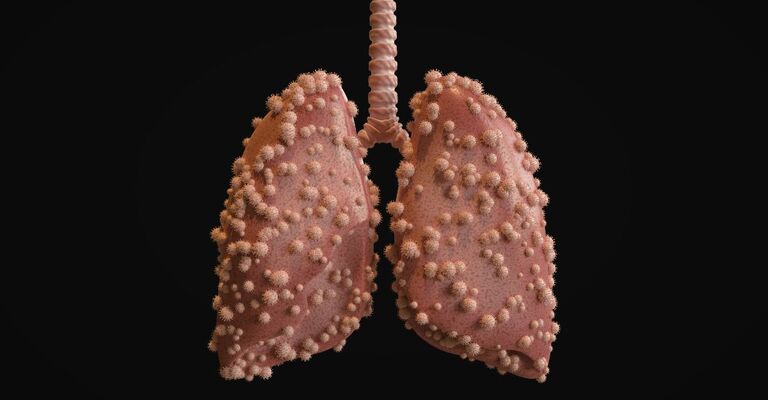 rappresentazione-di-polmoni-affetti-da-virus