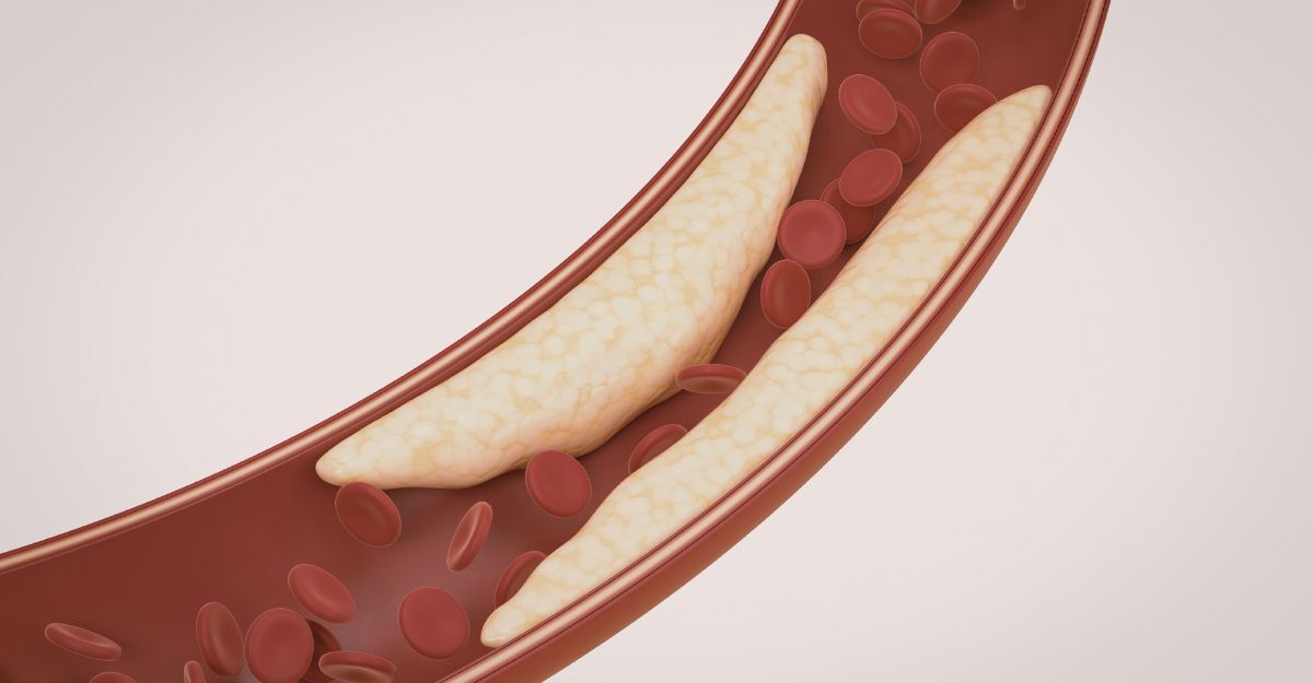 Illustrazione medica 3D di un'arteria con accumuli di placca giallastra e globuli rossi.
