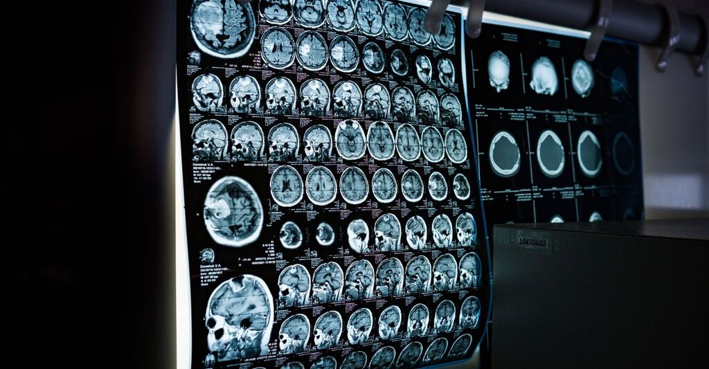 Un'ecografia al cervello