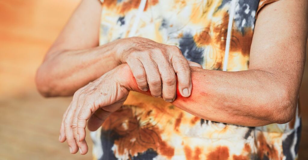 Una signora con uno sfogo sul braccio
