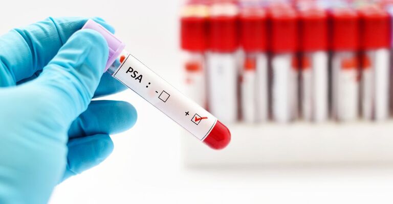Un infermiere che tiene in mano una fiala di sangue cons critto "PSA"