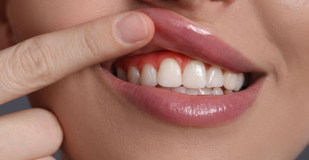 bocca che mostra denti e gengive