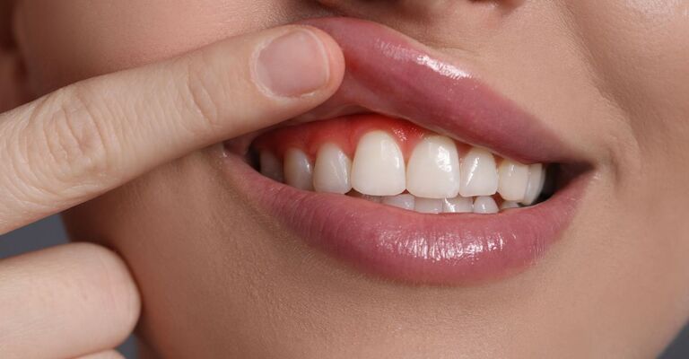 bocca che mostra denti e gengive