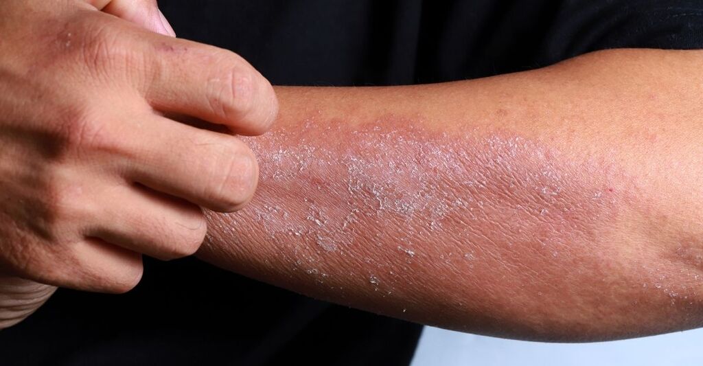 Un ragazzo con la dermatite