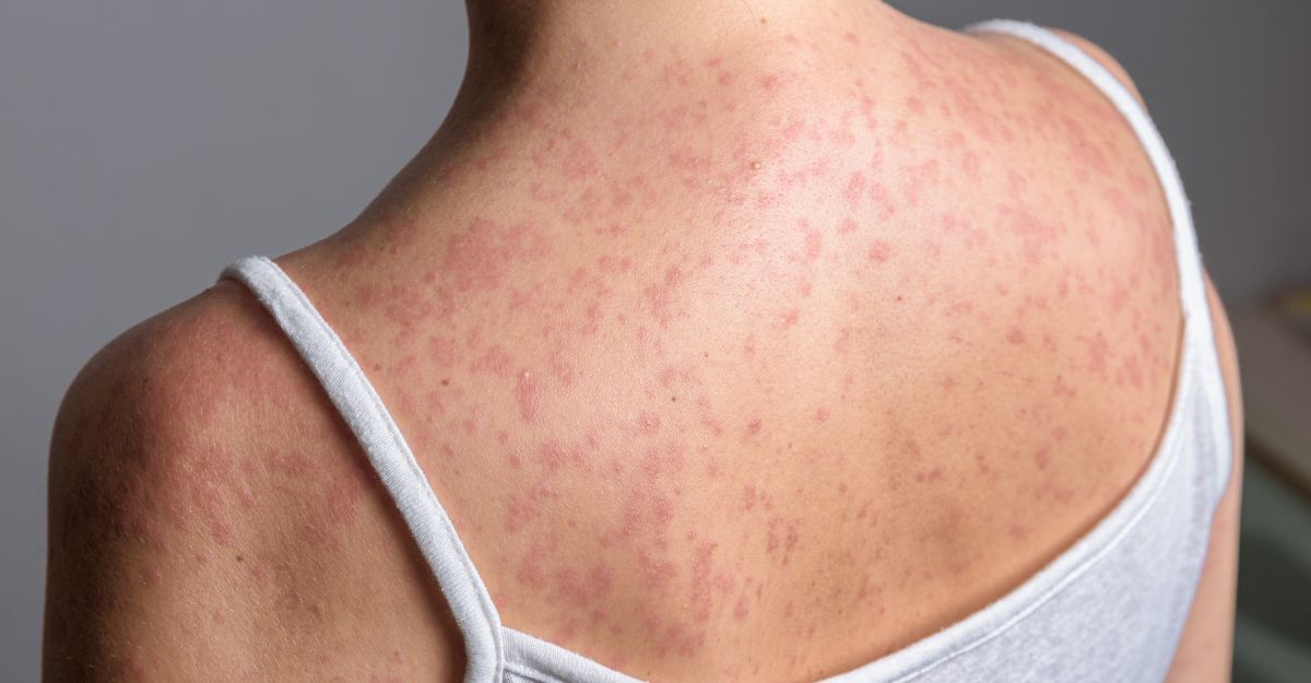 Una ragazza con il morbillo
